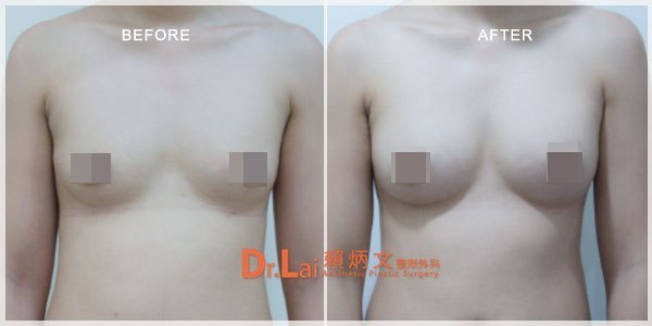为什么第一次脂肪移植丰胸的效果不好呢？脂肪丰胸真实案例图片