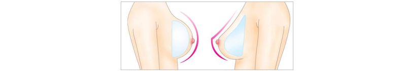 假体隆胸植入位置切口在哪里？水滴丰胸术前术后注意事项有哪些？