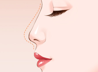 自体隆鼻又大约需要多久的休息时间才可以正常上班？韩式隆鼻拆线时间？