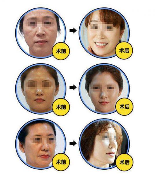 上海九院做面部提升最好的医生：金云波和李青峰（预约）怎么样？