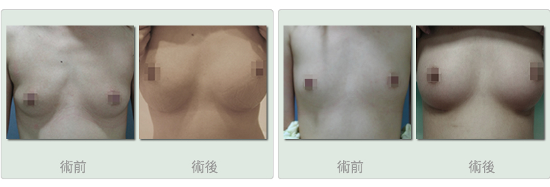 自体脂肪隆胸手术步骤图文详细介绍