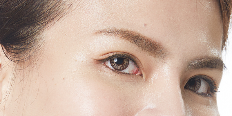 韩式微创双眼皮恢复期多久？韩式微创双眼皮需要全身麻醉吗？