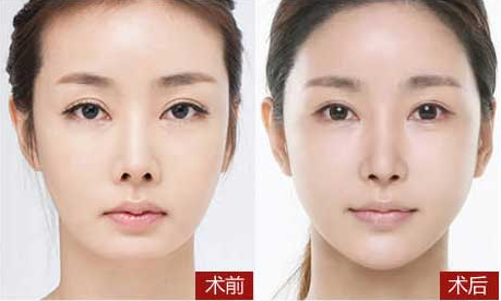 脸部面部的老化表现有哪些？皱纹变多脸部凹陷皮肤松弛