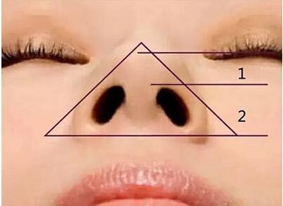 鼻基底是个啥?鼻基底填充有多重要?为什么要做鼻基底填充?