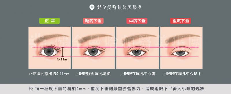 什么是眼睑下垂？眼睑下垂有哪几种类型？