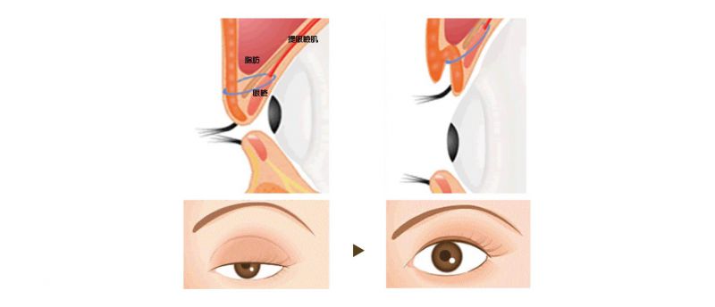 眼睑肌无力重症肌无力怎么治疗？提眼睑肌、割双眼皮和开眼头