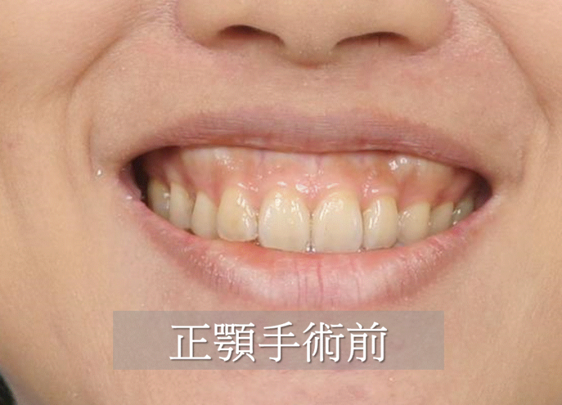 正颚手术对嘴形及笑容的改变(牙龈外露)有哪些？