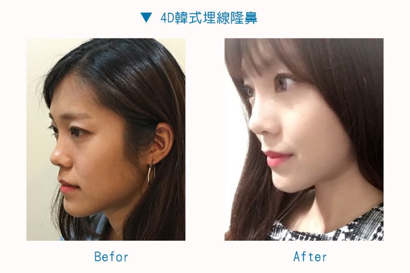 Misko韩式4D埋线隆鼻术术前术后注意事项禁忌症有哪些？