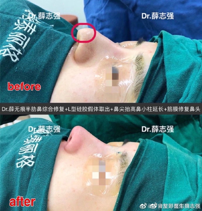 北京鼻综合好的三甲医院和医生都有哪些？