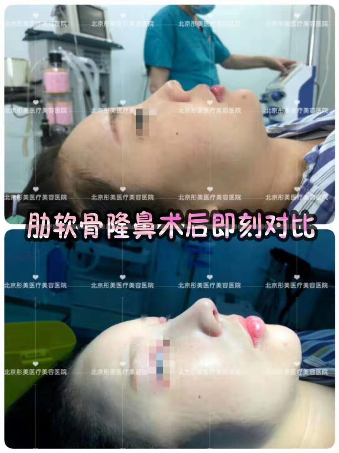 北京鼻子整形最好的医院有哪些？北京鼻综合医院排名预约