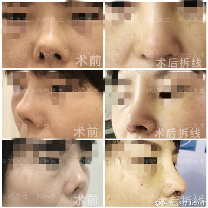 北京最厉害的隆鼻医生是谁？刘暾医生隆鼻技术怎么样？