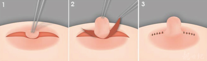 乳晕缩小切口位置一般在哪里？乳晕外缘和乳头周围