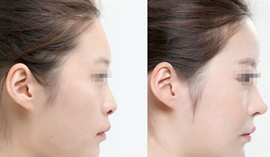 隆鼻整形手术时间多久？耳软骨或肋骨隆鼻时间需要多久？