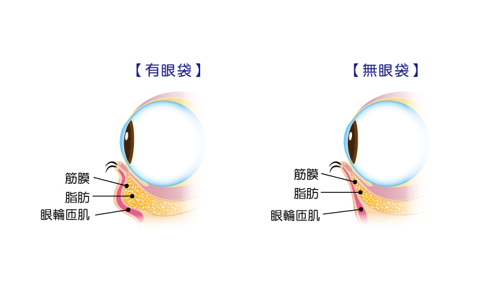 祛眼袋术后结膜水肿皮下瘀青下眼睑外翻怎么办？
