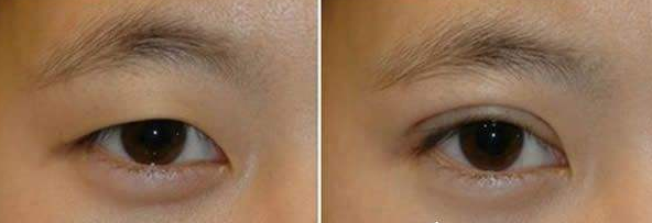 福州双眼皮修复最好的医生是哪个？