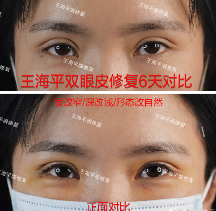 武汉做双眼皮修复最好的医生有哪些？