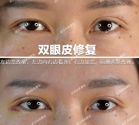 武汉王海平双眼皮修复技术怎么样？王海平眼修复案例预约