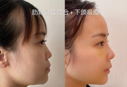 北京最有名气隆鼻专家是谁？北京隆鼻医生预约排名