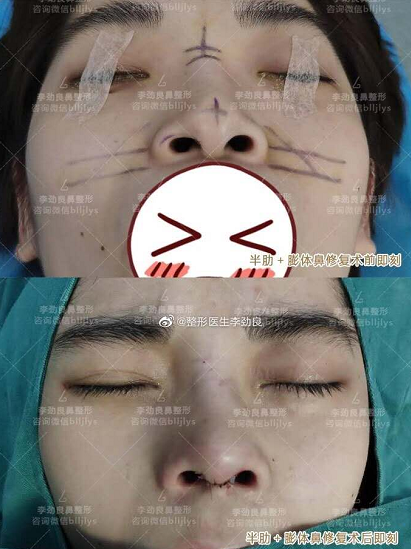 中国哪个医生取鼻子假体最厉害？取隆鼻假体医生排名