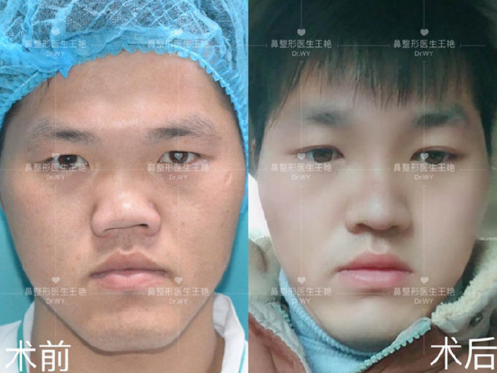 上海做畸形鼻修复的医生哪个好？畸形鼻修复专家预约排名