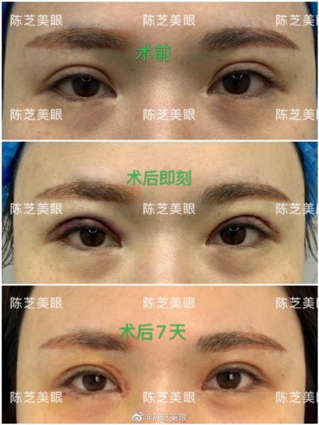 深圳做双眼皮修复最好的医生有哪些？