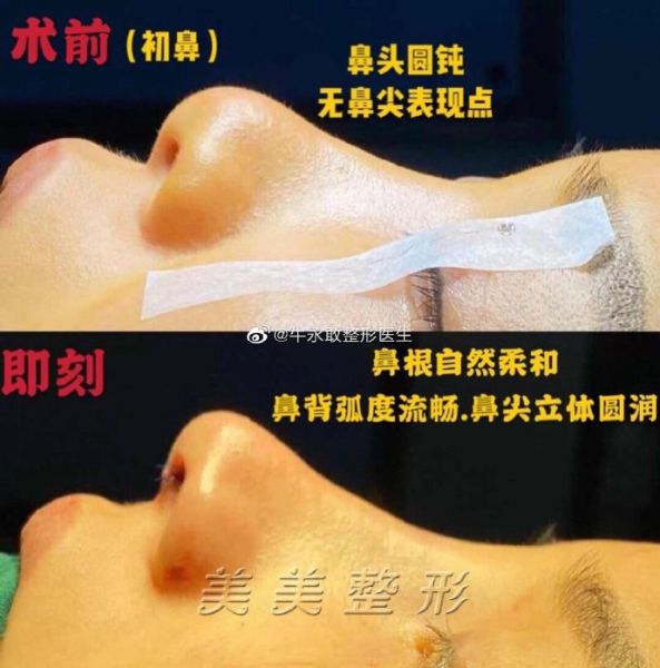 郑州最出名的鼻整形医生是哪个？牛永敢张洪波怎么样？