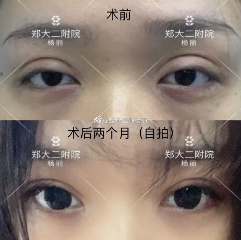 郑州做修复双眼皮好的医生是哪个？