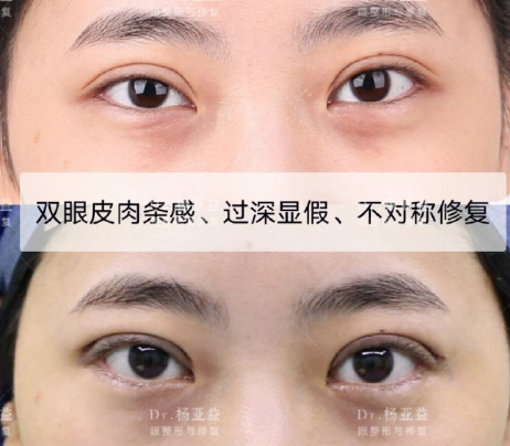 上海哪个医生双眼皮修复比较好？上海眼修复专家前十名