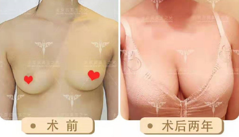 北京自体脂肪隆胸最好的医生预约排名大全