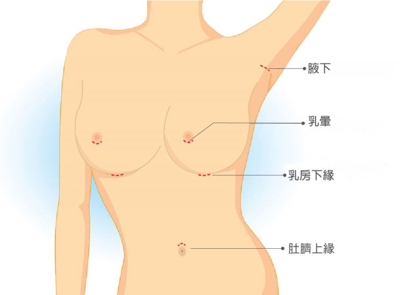 隆胸的假体材质有哪些？为什么要注重隆胸后的按摩？