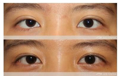上海九院双眼皮修复哪个医生比较好？朱惠敏、张余光、罗旭松、金云波