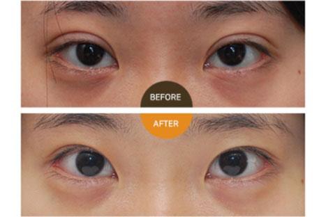 北京双眼皮修复比较好的医生有哪些？