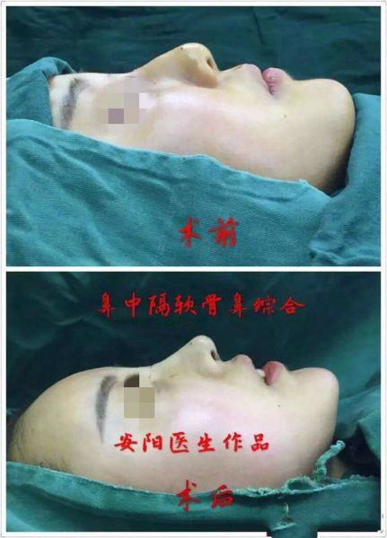 中国最好的肋软骨隆鼻医生有哪些？