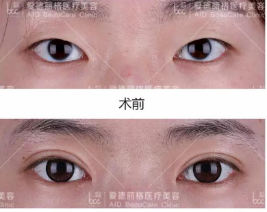 刘志刚和杜园园谁修复失败双眼皮谁技术更好？
