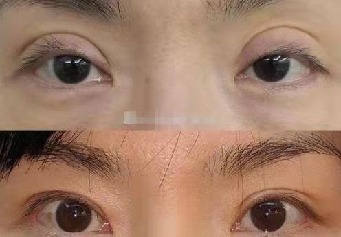 南京做双眼皮修复最好的医生预约排名