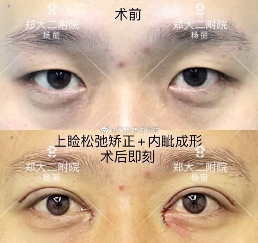 郑州刘月丽和杨丽谁做双眼皮技术更好些？