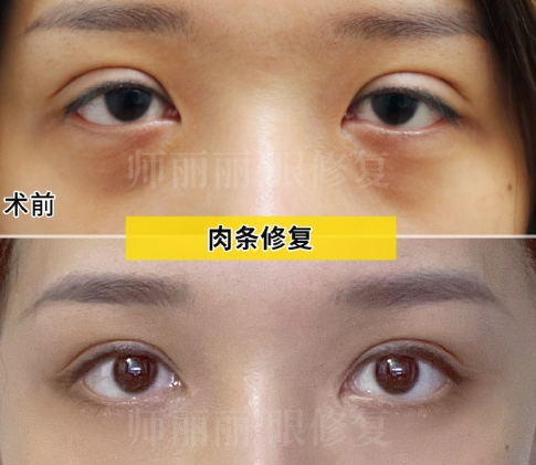 北京师丽丽修复双眼皮技术怎么样？