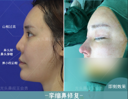 上海鼻修复哪个医生做得好？上海隆鼻专家前五名