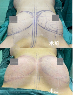 北京王沛森自体脂肪隆胸技术怎么样？