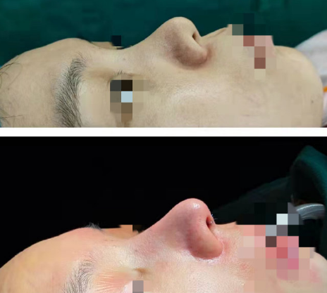 2022年深圳修复鼻子权威的医生有哪些？