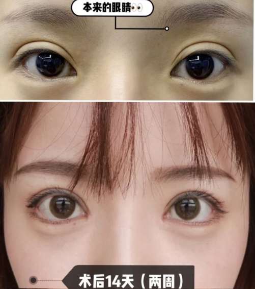 成都陈建华做双眼皮修复技术怎么样？