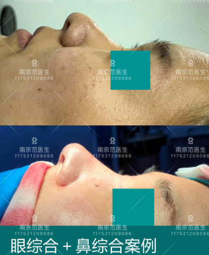 南京隆鼻专家范家鑫做鼻子怎么样？
