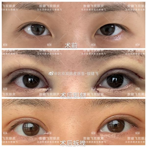北京双眼皮专家敖健飞割双眼皮怎么样？