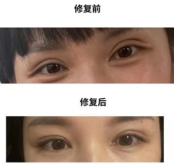 2022年深圳双眼皮修复最好的医生是哪个？