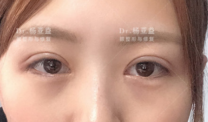 陈芝和杨亚益哪个修复双眼皮技术更好？