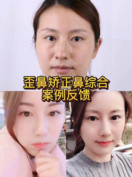 2022年上海九院哪个医生做歪鼻子手术好？