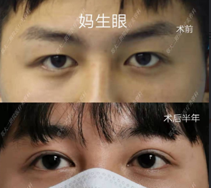 郑州双眼皮专家孔宇和杨丽谁割双眼皮技术好？