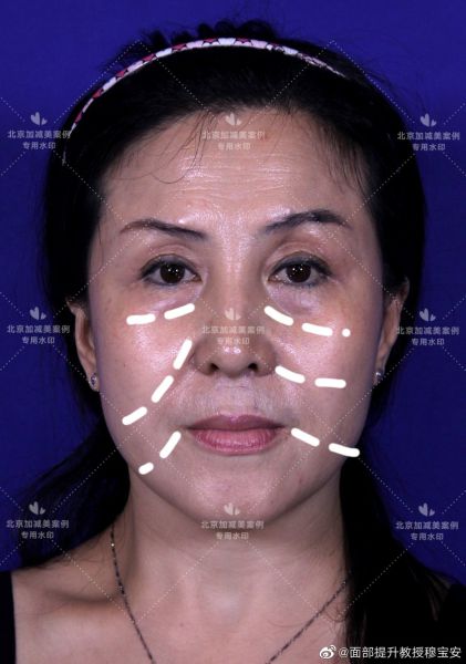 怎么让细纹减缓或减少发生？面部年轻化提升效果好吗？