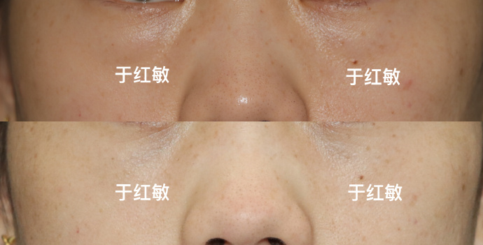 北京于红敏医生做眼袋技术口碑怎么样？