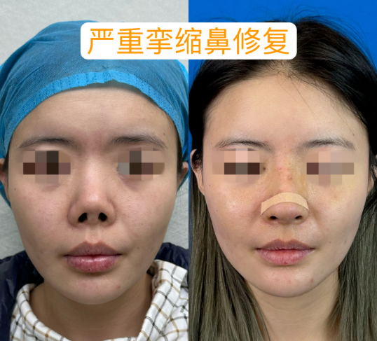 隆鼻修复医生刘波和陈付国做鼻修复谁厉害？